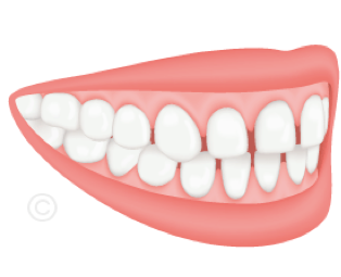 Fermeture d'espaces dentaires – Cabinet dentaire Boulogne-Billancourt
